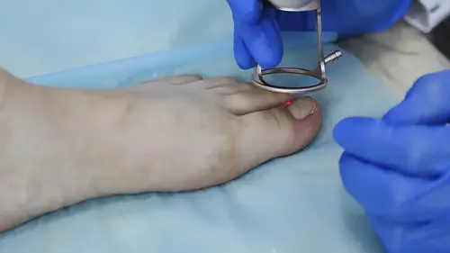 eliminación de uña encarnada